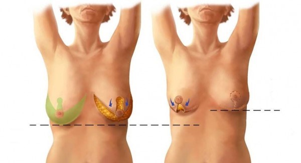 عملية تصغير الثدي في تونس