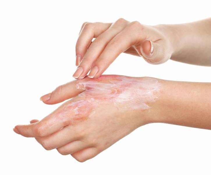 علاج الحروق في تونس : جراحة تجميل الحروق في تونس